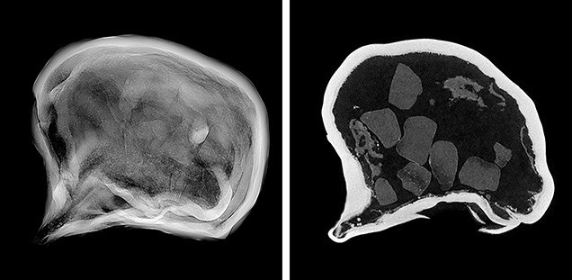 Figure 3. RTX image (left) and μ-CT image (right) of the 2.89 ct pearl with faint radiolucent material visible in the hollow void.