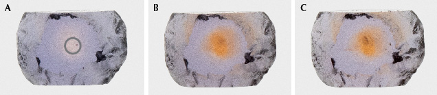 Figure 52. The Rock Creek sapphire in example 5, measuring 0.8 × 0.5 mm: unheated (A), heated to 1200°C in pure O2 (B), and heated to 1700°C in pure O2 (C). The gray circle shows area of analysis. Photos by Aaron Palke. Figure 52. The Rock Creek sapphire in example 5, measuring 0.8 × 0.5 mm: unheated (A), heated to 1200°C in pure O2 (B), and heated to 1700°C in pure O2 (C). The gray circle shows area of analysis. Photos by Aaron Palke.